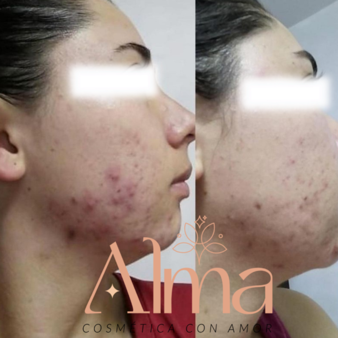 TÓNICO FACIAL DESPIGMENTANTE e iluminador Alma